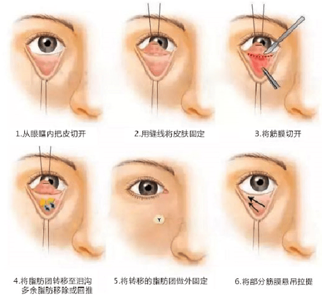 眶隔脂肪釋放術