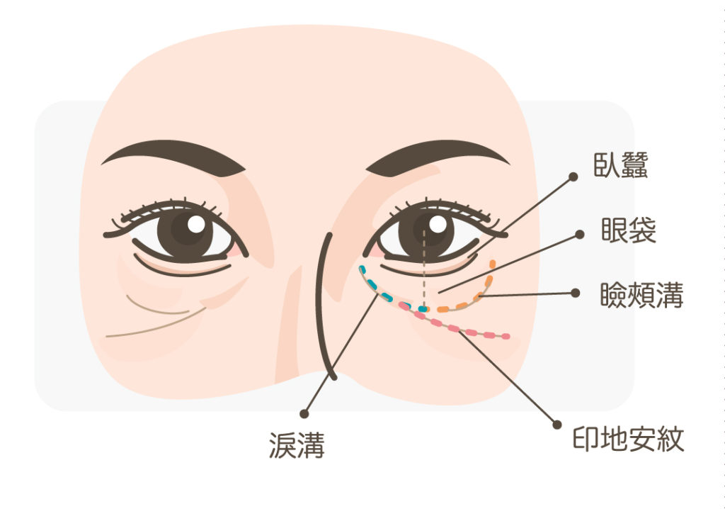 臥蠶 淚溝 示意圖 眼袋 醫美卡通 插畫 插圖 漫畫